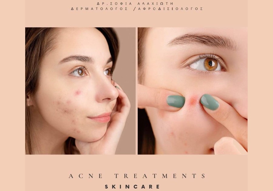 Θεραπεία Ακμής ( Acne Treatments Scincare )