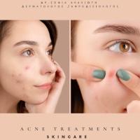 Θεραπεία Ακμής ( Acne Treatments Scincare )